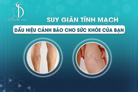 Review  Varikose – Kem bôi giảm suy giãn tĩnh mạch có tốt không ?